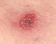 マダニの刺し口